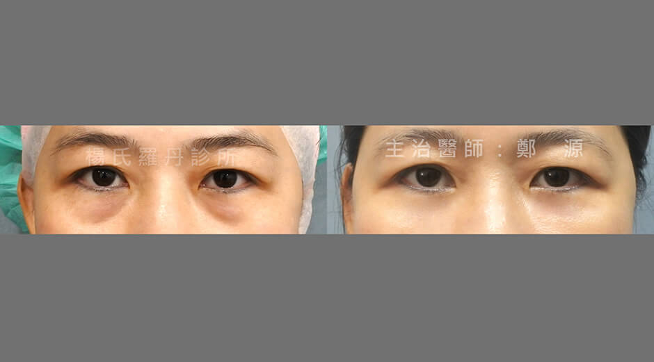 黑眼圈 楊氏羅丹,眼袋淚溝,眼袋,台北醫美